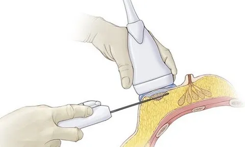 Hút u vú chân không có “thần kỳ” như quảng cáo?