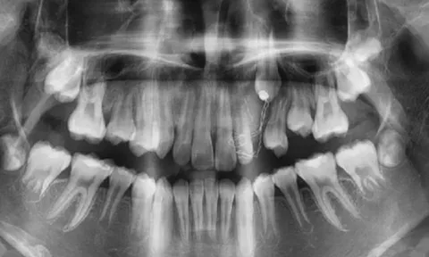 Thiếu niên 16 tuổi đột ngột sưng lợi, hoá ra u máu ác tính