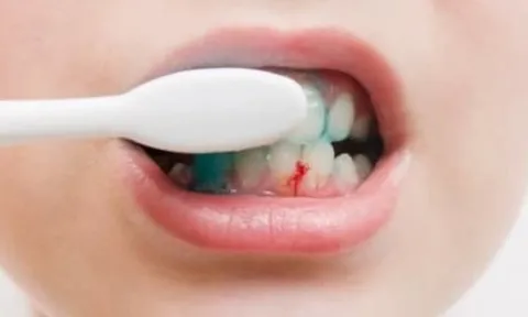 Dấu hiệu khi đánh răng cảnh báo gan nhiễm mỡ
