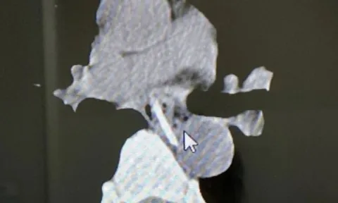 Hóc xương gà dài 3 cm, người đàn ông suýt mất mạng