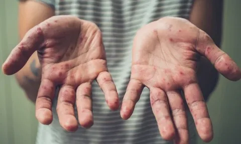 Chỉ trong 1 tuần TP HCM ghi nhận thêm 6 ca đậu mùa khỉ