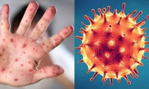 Người dân “gồng mình” phòng chống cùng lúc 5 loại dịch bệnh