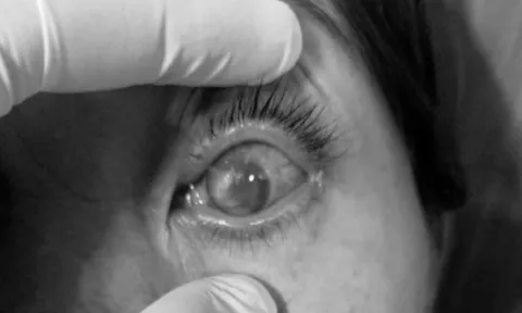 Tự mua thuốc điều trị đau mắt đỏ, bệnh nhân nữ bị loét giác mạc, mủ tiền phòng