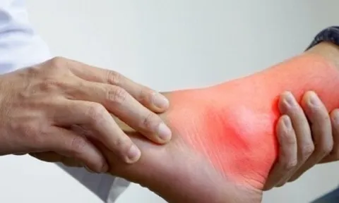 Bệnh gout có xu hướng trẻ hóa, bác sĩ chỉ cách phòng ngừa