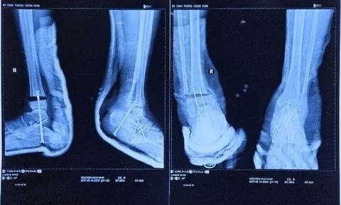 Hy hữu bệnh nhân bị đứt lìa cổ chân được phẫu thuật kịp thời