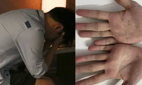 Sợ bị đậu mùa khỉ, nam thanh niên 26 tuổi đi khám mới phát hiện bệnh không ngờ