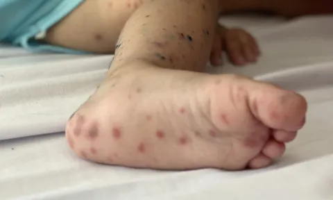 23 ca tử vong do tay chân miệng tại khu vực phía Nam