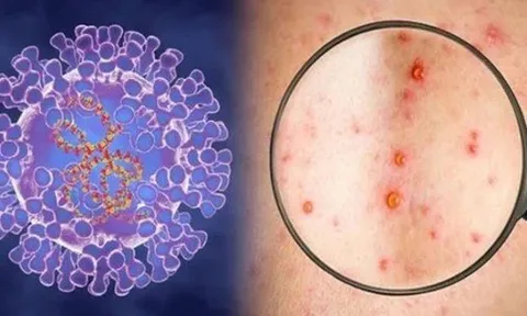Đã có kết quả xét nghiệm bệnh nhân nghi mắc đậu mùa khỉ ở Đà Nẵng