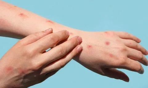 Trong 1 tuần TP HCM phát hiện thêm 15 ca đậu mùa khỉ