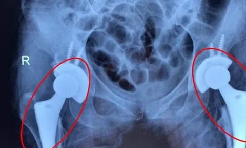 Nhiều người trẻ bị mục xương vì chất kích thích ai cũng dùng