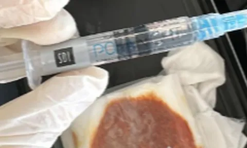 Tiêm filler trị thâm, nữ khách hàng bị tiêm ôxy già vào mắt