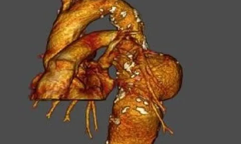 Cứu sống người đàn ông bị vỡ túi phình động mạch khi đang...chạy xe máy