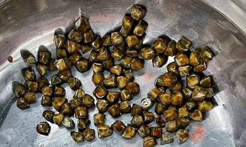 113 viên sỏi lấp đầy túi mật bệnh nhân