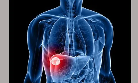 6 dấu hiệu cảnh báo ung thư gan nhiều người bỏ sót