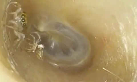 Thấy tiếng động lạ trong tai, người phụ nữ đi khám, phát hiện 'thủ phạm' kinh dị