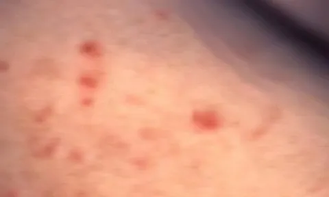 Người đàn ông có bạn tình cả 2 giới, bị lở loét vùng kín