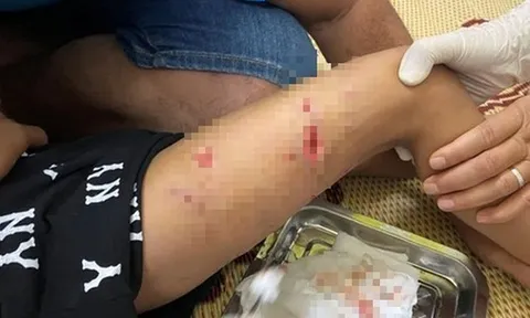 Ra đường chơi, bé 4 tuổi bị chó hàng xóm cắn dữ dội