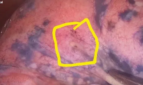 Lỗ rò xì bất thường trên người đàn ông 30 năm hút thuốc lá