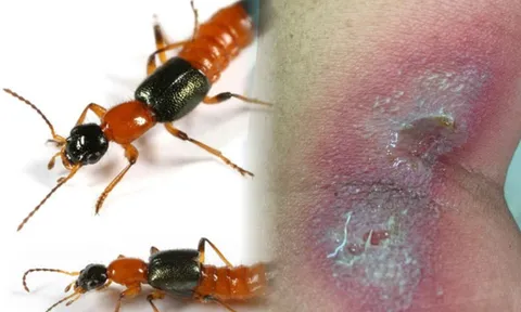 Kiến ba khoang vào mùa bùng phát, bác sĩ hướng dẫn cách xử trí