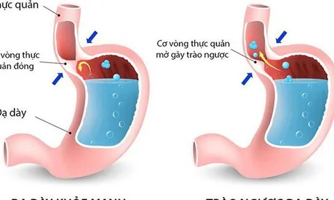 Bệnh trào ngược dạ dày - thực quản: 5 biến chứng nguy hiểm