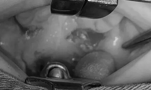 Chạy ngã khi đang ngậm que gỗ, bé trai bị đâm thủng vòm hầu