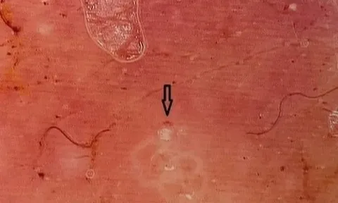 Bị ghẻ ở "của quý" nhưng phòng khám tư lại đốt để trị sùi mào gà