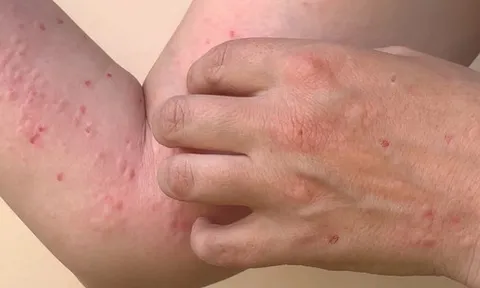 7 địa phương ghi nhận 56 ca nhiễm đậu mùa khỉ