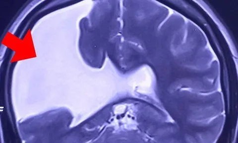 Người phụ nữ gần 30 năm sống chung với nứt não