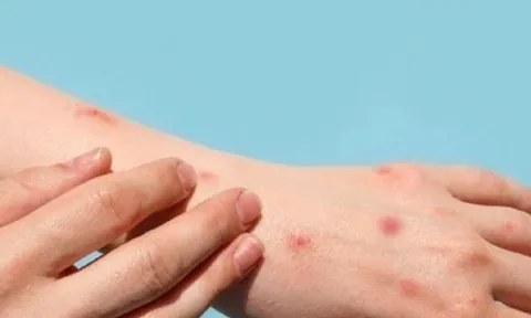 Bến Tre ghi nhận ca đậu mùa khỉ đầu tiên, bệnh nhân tiếp xúc với nhiều người