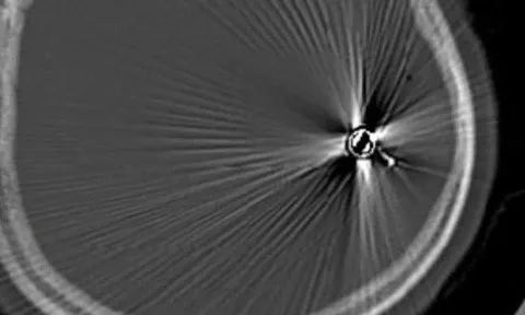 Đắk Lắk: Cứu sống cháu bé 12 tuổi bị đạn bắn vào đầu