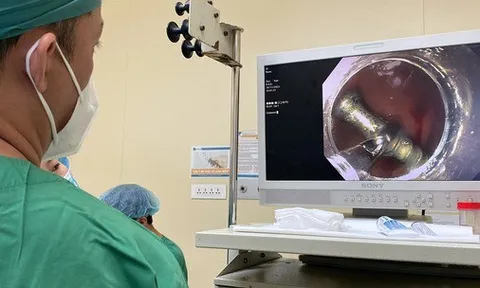 20 phút lấy đinh sắt trong bụng một bé trai