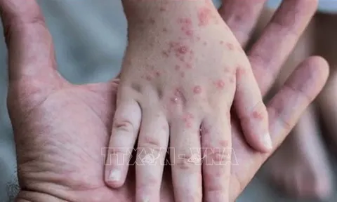 TP Hồ Chí Minh: 63 trường hợp mắc bệnh đậu mùa khỉ đều là nam giới