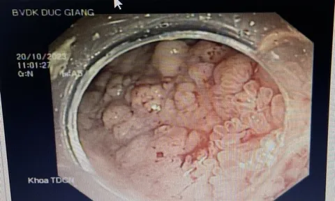 Vị trí đau tại bụng cảnh báo ung thư đại trực tràng