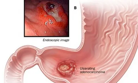 Phó Giám đốc Bệnh viện K chỉ rõ dấu hiệu cảnh báo sớm ung thư dạ dày