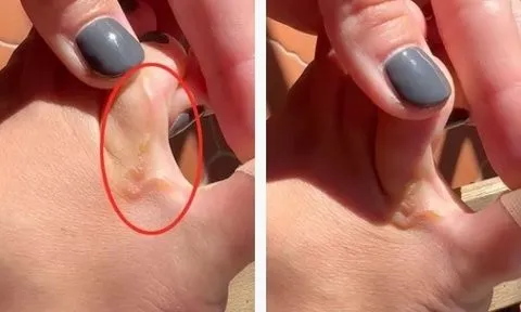 Chân ngứa dữ dội, cô gái phát hiện thứ kinh dị đang di chuyển dưới da