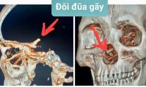 Bị bạn nhậu đâm đũa xuyên từ mũi lên não 5 tháng mà không hay biết