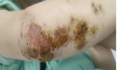 Nhiễm khuẩn, phù nề sau khi tắm bằng thuốc nam