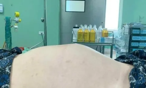 Thiếu nữ 18 tuổi bụng to như mang thai 7 tháng, không ngờ u buồng trứng ‘khủng’