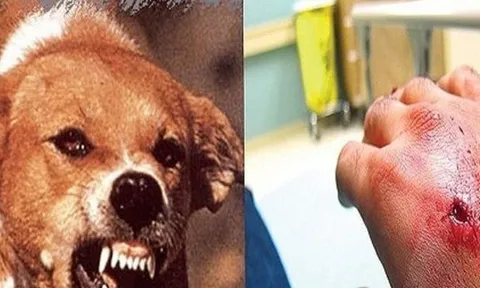 Chủ nhà tử vong sau 3 tháng bị chó cắn vào cổ tay