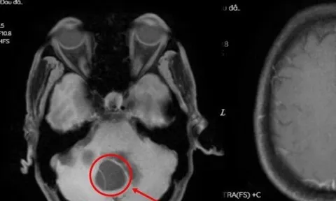 Sán làm tổ trong não do thói quen ăn tiết canh