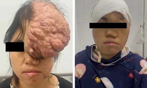 Ngỡ ngàng khuôn mặt cô gái sau 15 năm bị khối u khổng lồ đeo bám