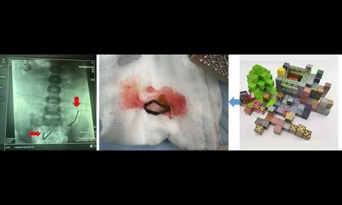 Ớn lạnh phát hiện 20 viên nam châm rỉ sét nằm trong bụng bé trai