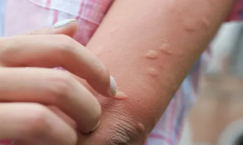 1 tuần, TP HCM ghi nhận hơn 2.000 ca bệnh do muỗi đốt