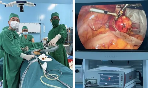 Bóc khối u có chứa da, tóc cho nữ bệnh nhân ở Côn Đảo