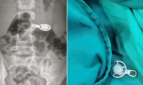 Nuốt móc khóa khi ngủ trưa, bé 4 tuổi phải nhập viện cấp cứu