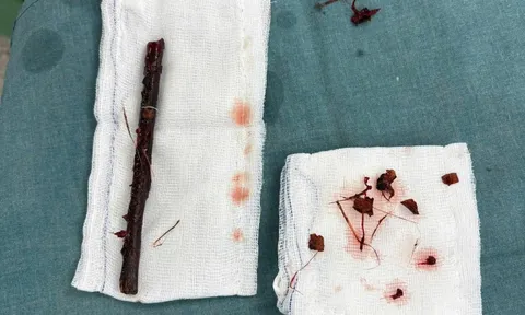 Hy hữu nhành cây dài 16 cm nằm trong bụng bé gái suốt 4 tháng