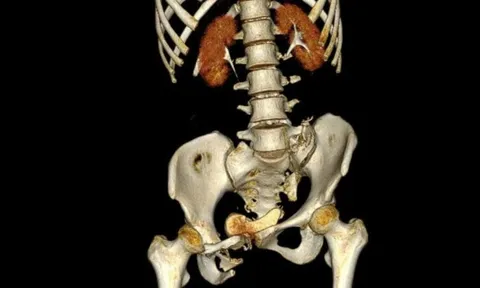 Cứu cô gái chấn thương nặng sau cú tông kinh hoàng của xe container