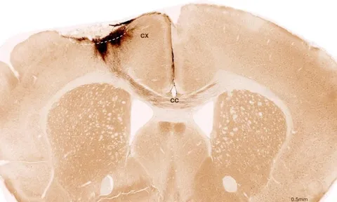 Tìm ra phương pháp mới hứa hẹn “đảo ngược” đột quỵ