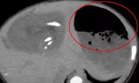 Bụng bé gái sưng to bất thường, bác sĩ phát hiện ra "bí mật" đáng sợ