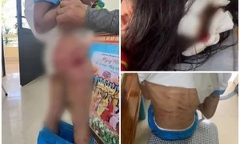Công an điều tra vụ bé gái lớp 5 bị cha dượng bạo hành ở Hà Tĩnh
